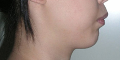 上顎前突/天包地術(shù)前