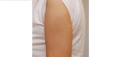 隔空溶脂瘦手臂術(shù)后