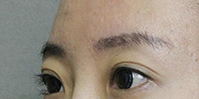玻尿酸豐眉弓術(shù)前
