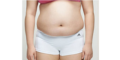 腰部吸脂術(shù)前