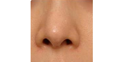 鼻部膨體假體取出術前