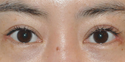眼部修復(fù)術(shù)后