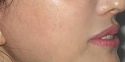 手術(shù)去法令紋術(shù)后