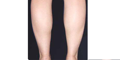 冷凍溶脂瘦小腿術(shù)前