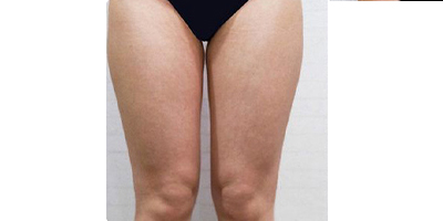 動(dòng)氧瘦大腿術(shù)前