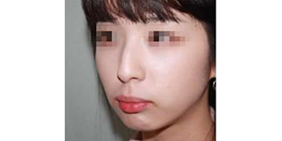 鷹鉤鼻矯正術(shù)前