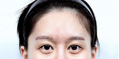 假體豐太陽(yáng)穴術(shù)前