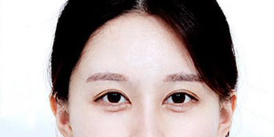 假體豐太陽(yáng)穴術(shù)后