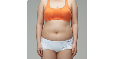 全身吸脂術(shù)前