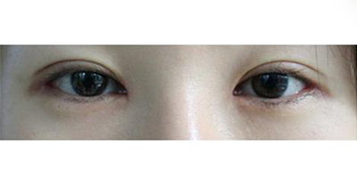 內(nèi)眥修復(fù)術(shù)術(shù)后