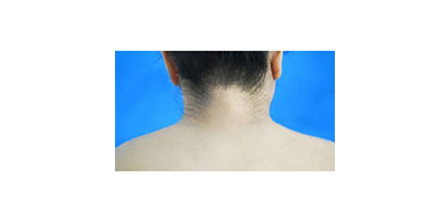 冷凍溶脂瘦肩膀術(shù)后