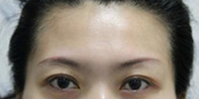 自體脂肪豐太陽穴術前