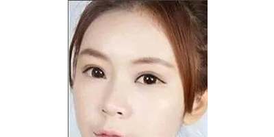 玻尿酸豐臥蠶術(shù)前