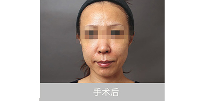 自體脂肪存儲術后