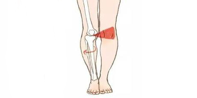 xo型腿矯正術(shù)前