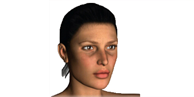 玻尿酸去黑眼圈術(shù)前