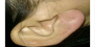 玻尿酸豐耳垂術(shù)后