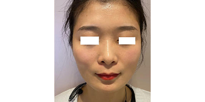 玻尿酸豐太陽穴術(shù)后