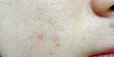 果酸煥膚術(shù)前