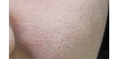 玻尿酸導(dǎo)入術(shù)前