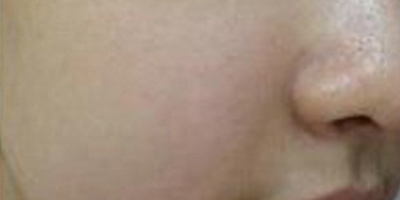 水光補(bǔ)水術(shù)后