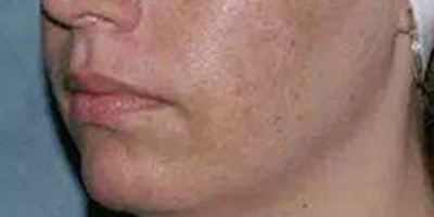 E光祛斑術(shù)前