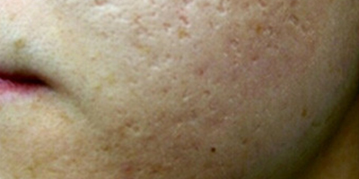 化學(xué)換膚術(shù)前