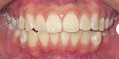 金屬托槽矯正術前