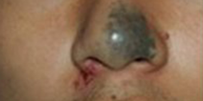 激光去胎記術前