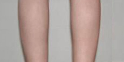 注射瘦小腿術后