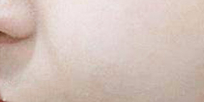 美白導(dǎo)入術(shù)后