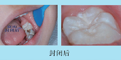 兒童口腔預(yù)防窩溝封閉術(shù)后