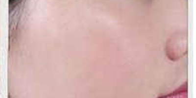 IPL美膚術(shù)后