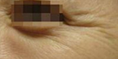 注射去魚尾紋術(shù)前