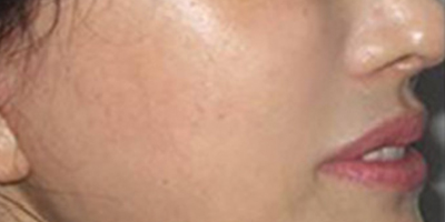 自體脂肪去法令紋術(shù)后