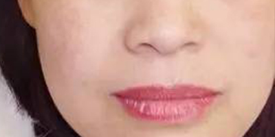 經(jīng)絡(luò)凈排術(shù)后