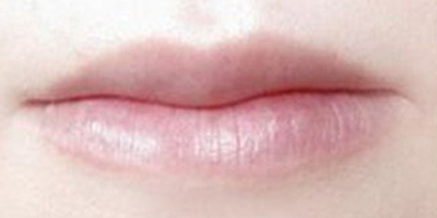 自體脂肪豐唇術(shù)前