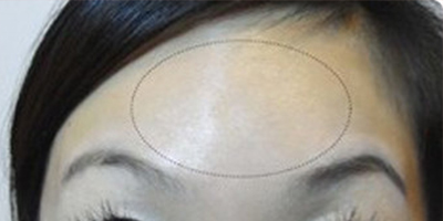 注射去動(dòng)態(tài)紋術(shù)后