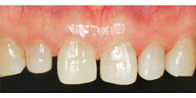 全瓷牙術(shù)前