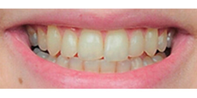 超聲波洗牙術(shù)前