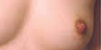 乳頭內陷矯正術后