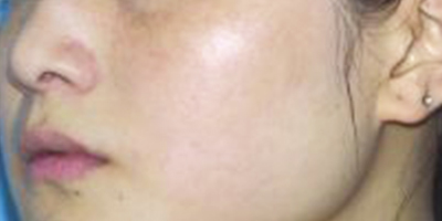 生美祛斑術(shù)后