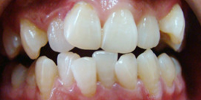 自鎖托槽矯正術(shù)前