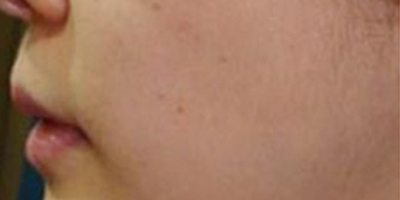 水光娃娃術(shù)前