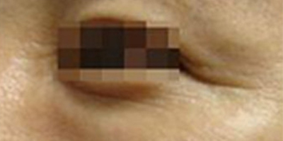 注射去魚尾紋術(shù)后