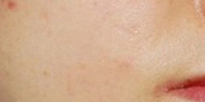 清痘針術(shù)后