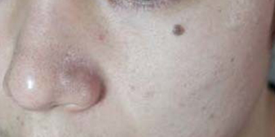 激光點(diǎn)痣術(shù)前