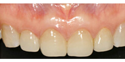 全瓷牙術(shù)后