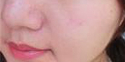 海菲秀術(shù)前