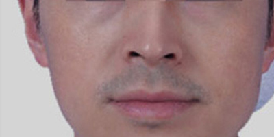 M22王者之冠術后